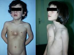 Image result for Pectus Excavatum