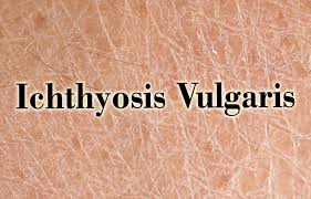 Image result for Ichthyosis