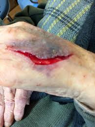 石井整形外科 - 80代男性手背表皮剥離創 | Facebook