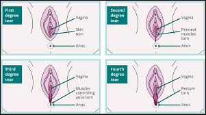 Maybe you would like to learn more about one of these? Information For Women Third And Fourth Degree Perineal Tears Clinical Care Standard Australian Commission On Safety And Quality In Health Care