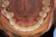 Fixed Retainer – Permanent Protection for a Straight, Stable Smile