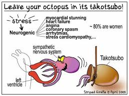 Takotsubo Stress Cardiomyopathy A K A Broken Heart Syndrome Broken Heart Syndrome Stress Cardiomyopathy Takotsubo