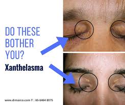 Image result for xanthelasma of eyelid