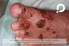 Ulcus Cruris Offenes Bein Dermanostic Hautlexikon