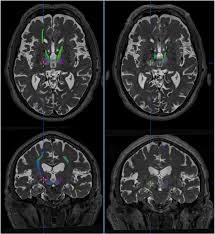Image result for Thalamotomy