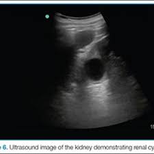 Before ultrasound study, patients were. Emergency Ultrasound Renal Evaluation Mdedge Emergency Medicine