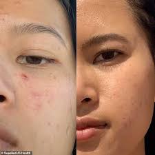 Think of our skin + digestion vitamins as a tool when experiencing conditions such as symptoms of acne, pimples, skin eruptions, mild eczema or dermatitis. Student Reveals The Diet And Skincare Regime That Cleared Up Her Embarrassing Acne Using Js Health Newsopener