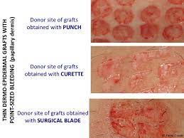 Which Dressing Should I Choose To Cover The Skin Graft Donor Site