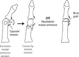 Image result for Hallux Varus