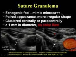 The initial stage of throat cancer will start with vague and nonspecific symptoms and later it will start developing into unresolved lump or growth. Ultrasound Of The Neck There S More To See Than Thyroid Nodules Youtube