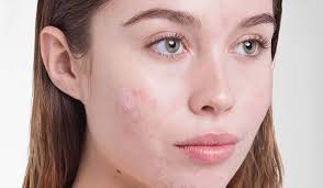 Banyak petua hilangkan parut jerawat dengan cepat dan semulajadi. Cara Nak Hilangkan Jerawat Hitam Nuring