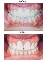 Make sure you are honest with your dentist about how long you've been wearing your trays so they can recommend the best course forward for. Invisalign Facts You Need To Know People Com