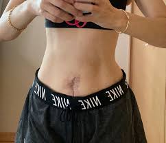 子宮 筋腫 全 摘 ブログ