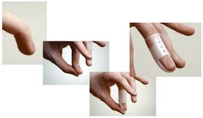 Commonly an athletic injury, mallet finger occurs when the outermost joint of the finger is injured. Mallet Finger Injury Dr Jonathan Lee Yi Liang