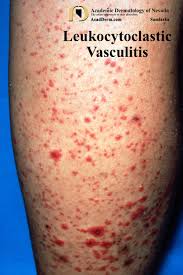 Image result for Vasculitis