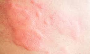 Image result for heat rash under breasts