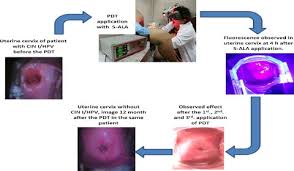 11 am pdt to moscow time. Effectiveness Of Photodynamic Therapy In Elimination Of Hpv 16 And Hpv 18 Associated With Cin I In Mexican Women Maldonado Alvarado 2017 Photochemistry And Photobiology Wiley Online Library