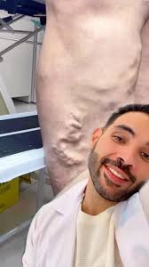 Si la espuma es una linda opción de tratamiento de las várices …, Y vos qué  opinas ?👇🏼👇🏼👇🏼