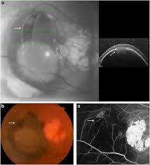 Search for instant quality results at helping.com. Retinal Pigment Epithelial Tear Resembling Retinal Tear Eye