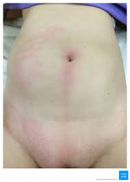 Necrotizing fasciitis is rarely contagious. Necrotizing Fasciitis Diagnosis Treatment Images Kenhub