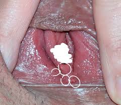 Maybe you would like to learn more about one of these? Vestibular Papillae Causes Is Vestibular Papillomatosis Itchy Vestibular Papillae Itching