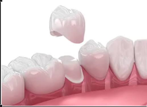 Dental Crowns product image