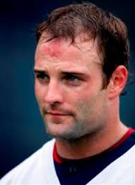 New england patriots wide receiver wes welker is the new face of male pattern baldness. Patriots Wide Receiver Welker Has Hair Transplant Regrowth Your Source Of Hair News