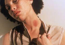 How To Get Rid Of A Hickey – Cleveland Clinic