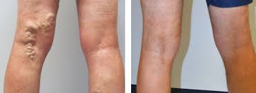 Operaciya Po Udaleniyu Varikoznyh Ven Na Nogah Hirurgicheskoe Udalenie Ven Pri Varikoze Ceny V Moskve Hirurgiya Ven