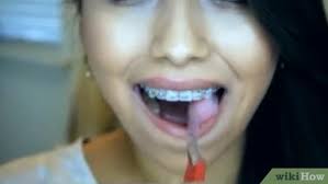 The dentist goes into detail on how to keep your teeth clean while wearing different types of braces or other dental appliances that move your teeth. How To Brush Your Teeth With Braces On With Pictures Wikihow