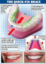 Inman aligners only need to be worth around 16 hours per day while a patient being treated with an inman aligner is likely to only require a single aligner throughout the treatment, invisalign retainers. Inman Aligner Liverpool Crosby Dental