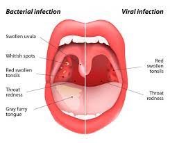 Learn vocabulary, terms and more with flashcards, games and other study tools. 676 Tonsil Vector Images Free Royalty Free Tonsil Vectors Depositphotos