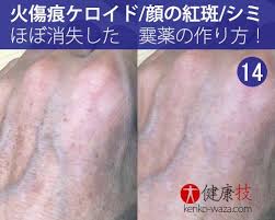 なんと 火傷痕ケロイドや顔の紅斑もほぼ消失する霙 みぞれ 薬の作り方14 health and beauty tips body treatments kenko