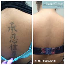 Laser tattoo removal cost 250 usd per session on average. Tattoo Removal Treatment Laser