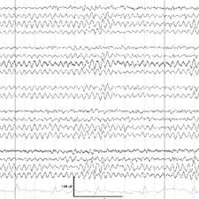 Pdf Electroencephalography In The Elderly