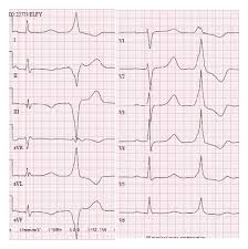 Image result for Extrasystole