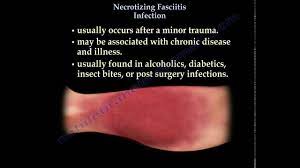 Maybe you would like to learn more about one of these? Necrotizing Fasciitis Flesh Eating Disease Physiopedia