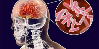 Sakit kepala karena tegang juga bisa menyerang bagian kepala belakang dan bagian kanan kepala. Leher Kaku Dan Kepala Pusing Mungkinkah Gejala Meningitis