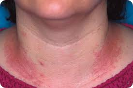 Image result for dermatitis contacta allergica