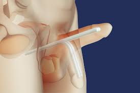 Image result for Penile Prosthesis