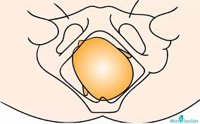 Image result for Manual Rotation in Occipitoposterior Presentation