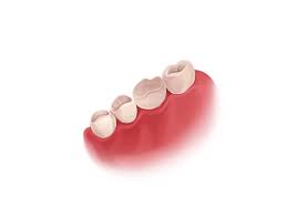 The cost of any filling will depend on whether it is a front or back tooth and the severity of the procedure. Cavity Filling Types And Procedure Authority Dental