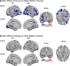 Consultancy, deployment, training and support services. The Effect Of Age On Vertex Based Measures Of The Grey White Matter Tissue Contrast In Autism Spectrum Disorder Molecular Autism Full Text