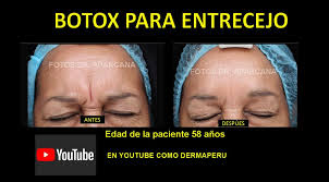Esto ha causado efectos secundarios graves que amenazan la vida de algunas personas que reciben inyecciones de botulinum toxin, hasta por razones cosméticas. Derma Peru Botox Toxina Botulinica Para Entrecejo Y Facebook