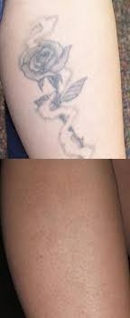 Learn how to create your own. Laser Tattoo Removal Washington Dc Cosmetic Skin Institute Skin Care In Washington Dc Olney Maryland