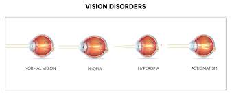 Image result for Refractive Error