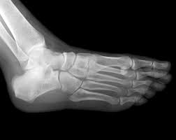 Image result for Foot XRay