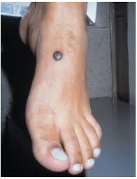 Image result for Blue Nevus