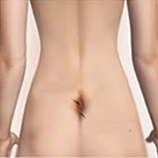 As such is it often also termed an intergluteal pilonidal sinus. Pilonidal Sinus Treatment In Coimbatore Pilonidal Sinus Doctors In India