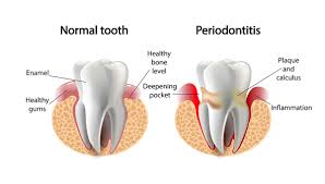 Image result for Periodontitis